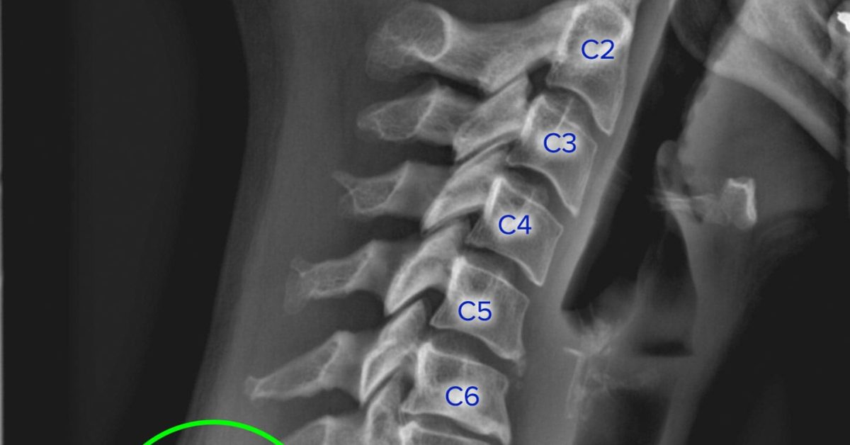 Radiograph showing broken cervical vertebrae.